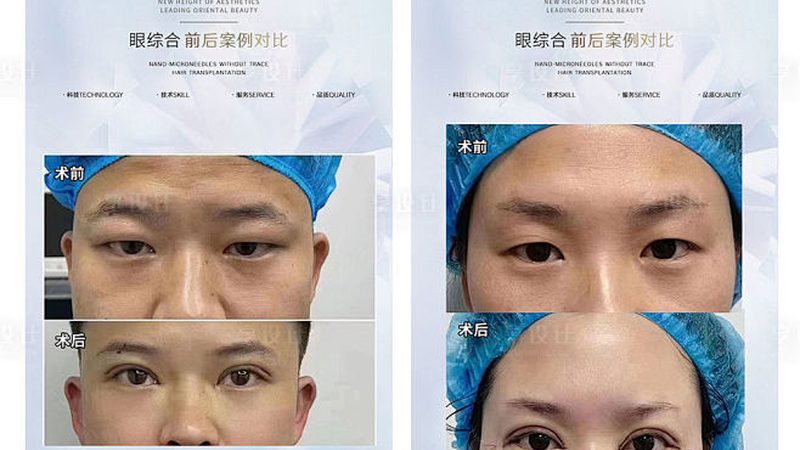 热玛吉操作步骤揭秘：专业培训课程助你掌握美容新技能