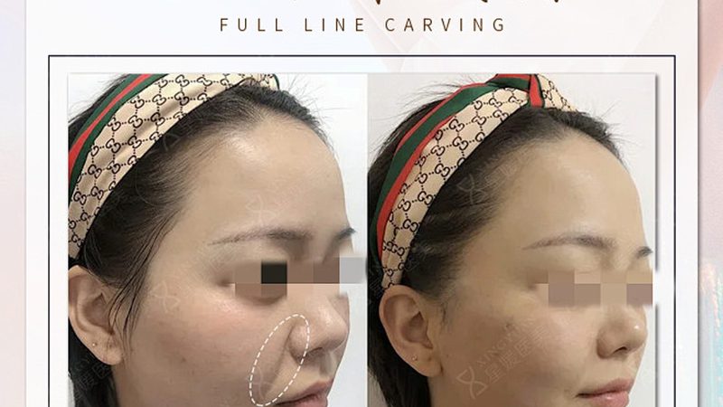 年龄与注射美容：揭秘适合你的美丽方案