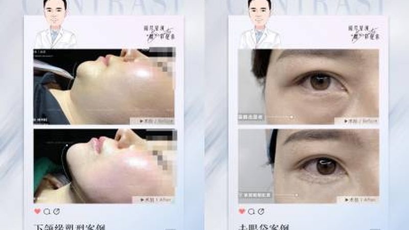 瘦脸针术后多久可以运动？揭秘恢复期注意事项