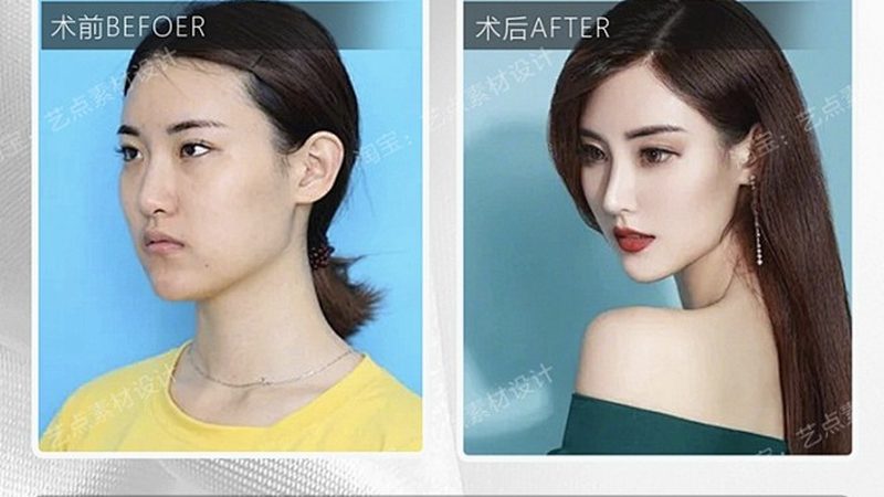 面部脂肪填充失败修复，揭秘成功的关键