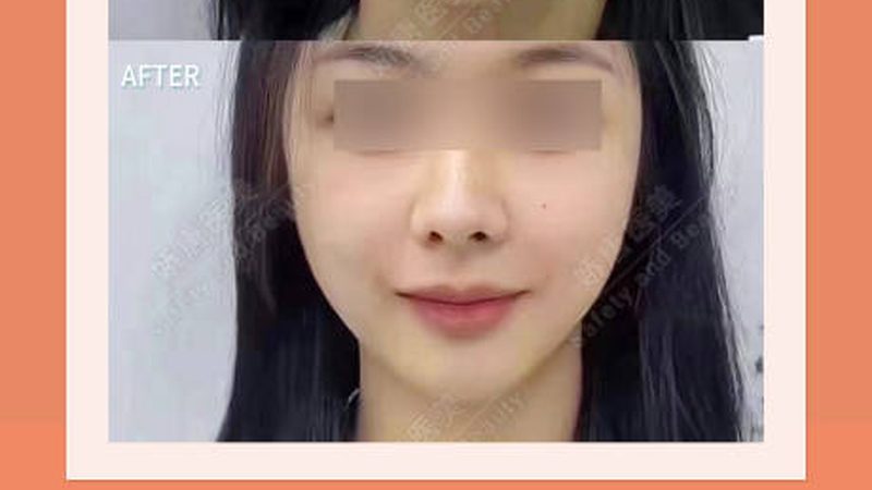 揭秘抗衰激光与超声刀：技术原理与选购要点
