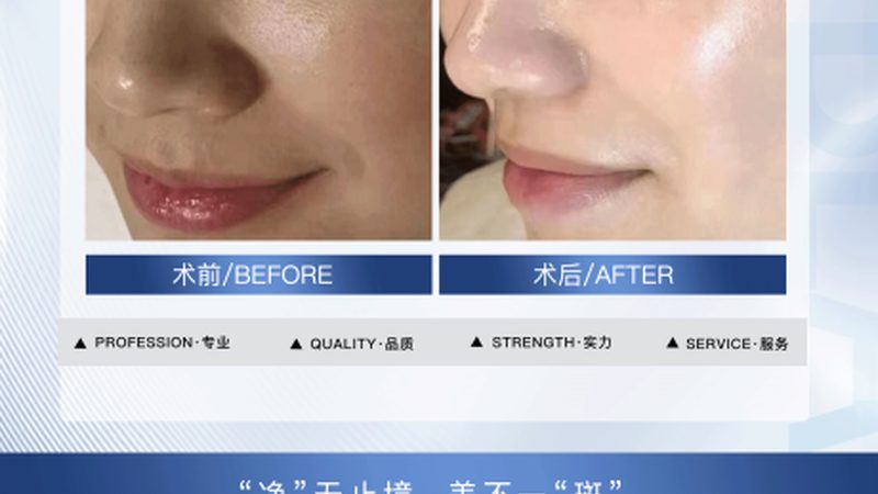 全切双眼皮与埋线双眼皮：材质大揭秘