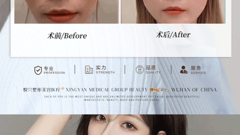 成都埋线提升与线雕：揭秘两种面部年轻化术式的区别