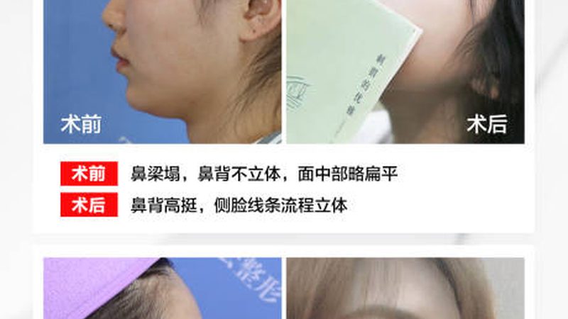 肉毒素全脸注射：揭秘价格背后的真相