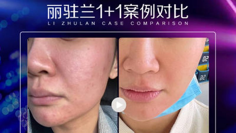 光子嫩肤仪美容院采购注意事项